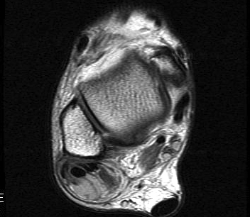 Peroneal Tendonitis MRI